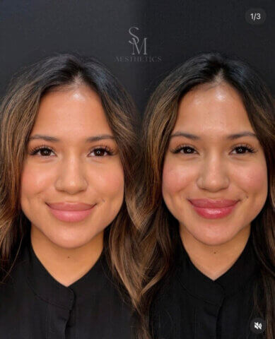 Side by side photos of a woman who had botox